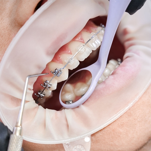 BRACKETS (ORTODONCISTA)